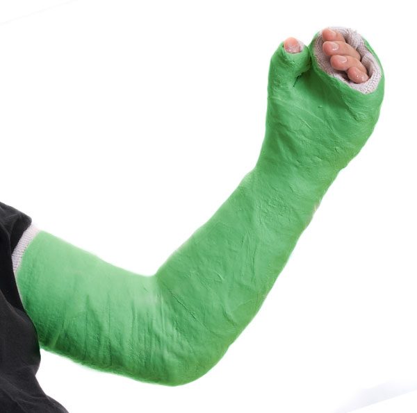 hand-fracture