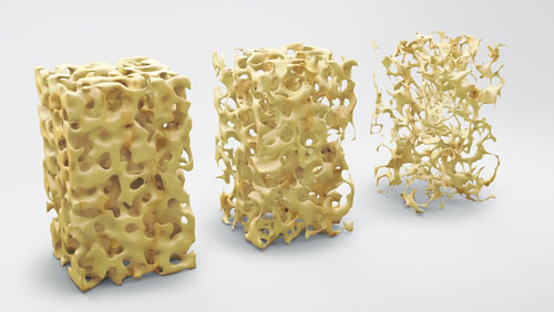 Osteoporosis-Visual-Aid