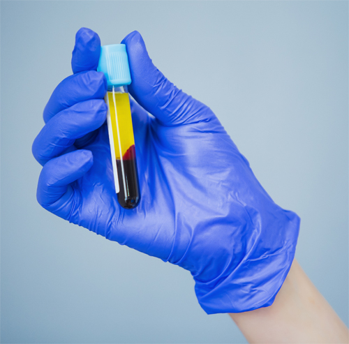 PRP-Therapy